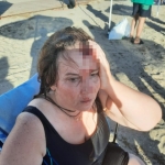 Denizde yüzerken jet ski çarptı, ölümden döndü