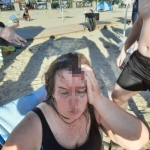 Denizde yüzerken jet ski çarptı, ölümden döndü