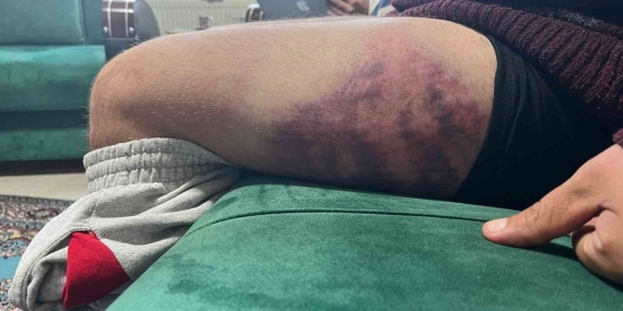 Vicdanları yaralayan olay: Otizmli şahıs odunluğa baktı diye odunla darbedildi